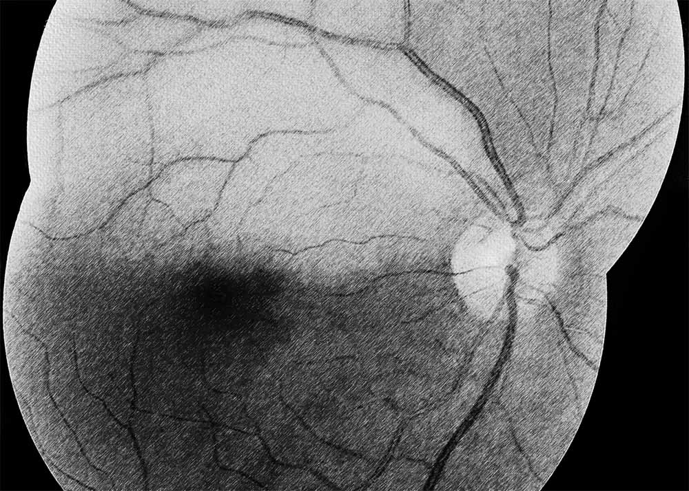 Retinal Artery Occlusion (RAO) (1) Retinal Artery Occlusion