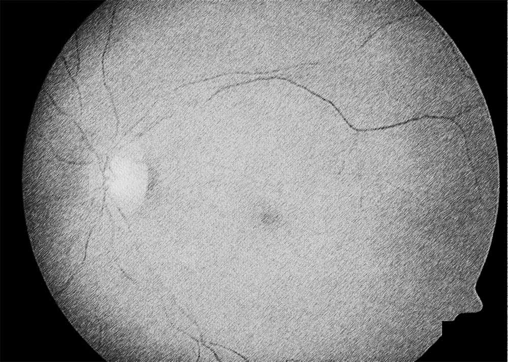 Retinal Artery Occlusion (RAO) (2) Retinal Artery Occlusion
