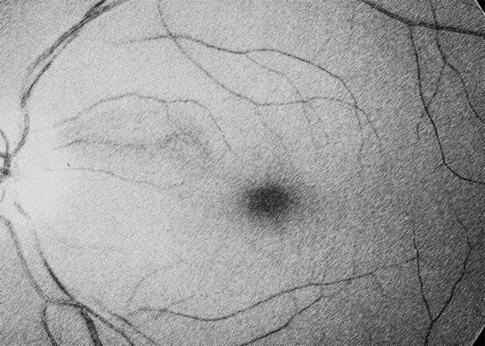 Retinal Artery Occlusion