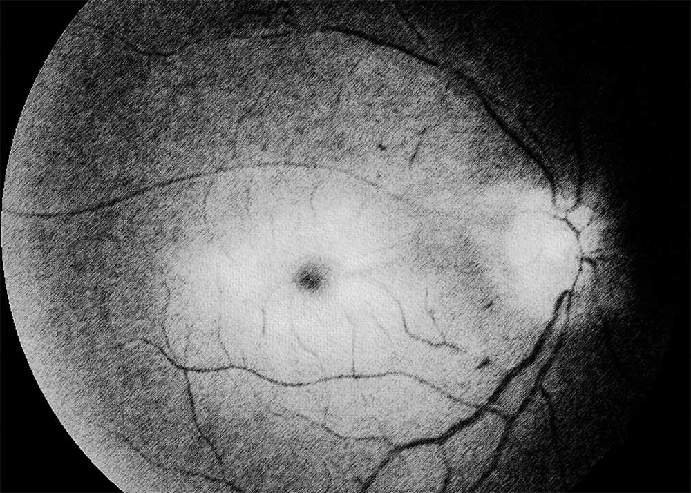 Retinal Artery Occlusion (RAO) (4) Retinal Artery Occlusion