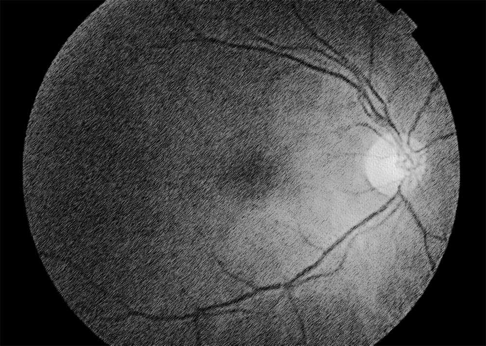 Retinal Disorders General