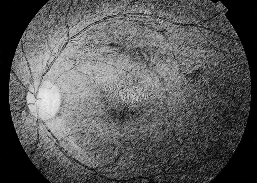 Retinal vein occlusion (CRVO)