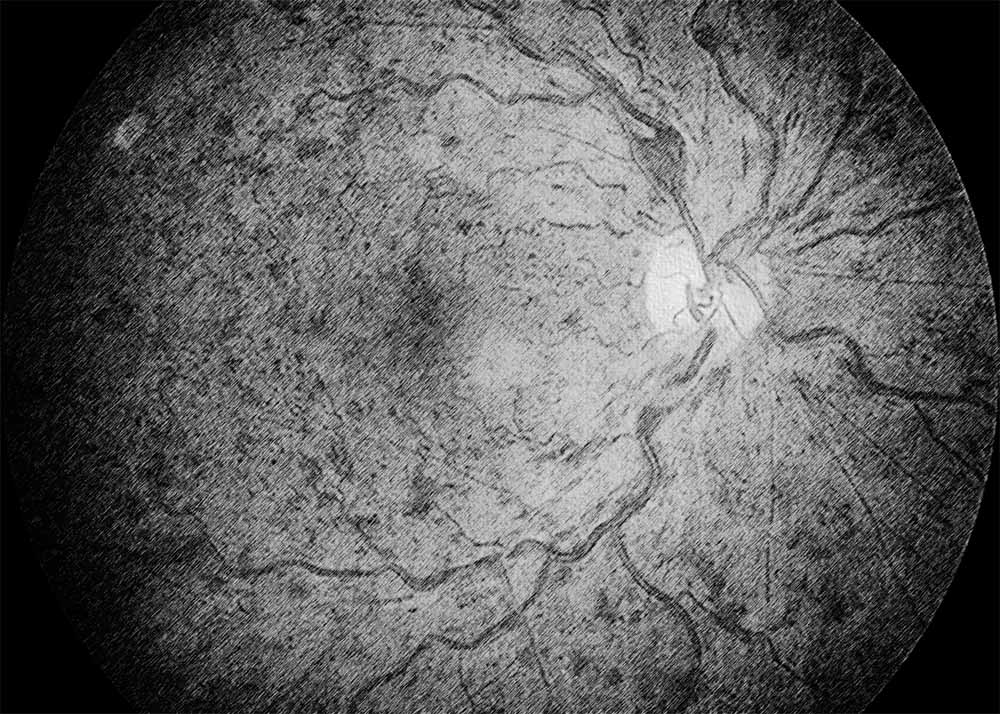 Retinal vein occlusion (CRVO)