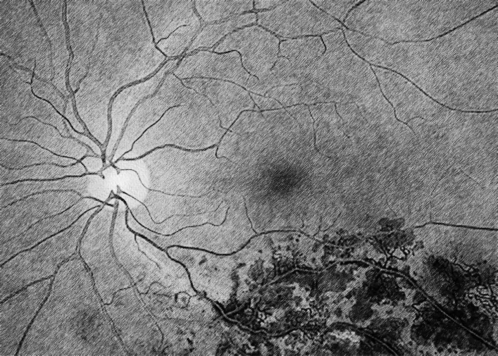 Retinal vein occlusion (CRVO)