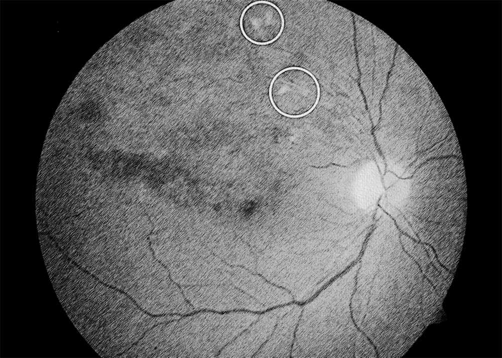 Retinal vein occlusion (CRVO)