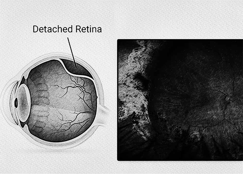 Retinal detachment (2) Retinal detachment