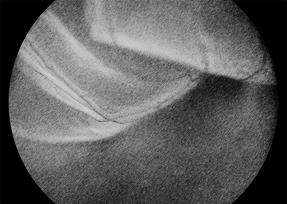 Retinal detachment (4) Retinal detachment