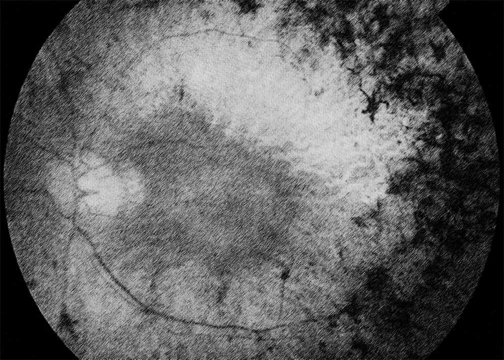 Retinitis pigmentosa (1) Retinitis Pigmentosa