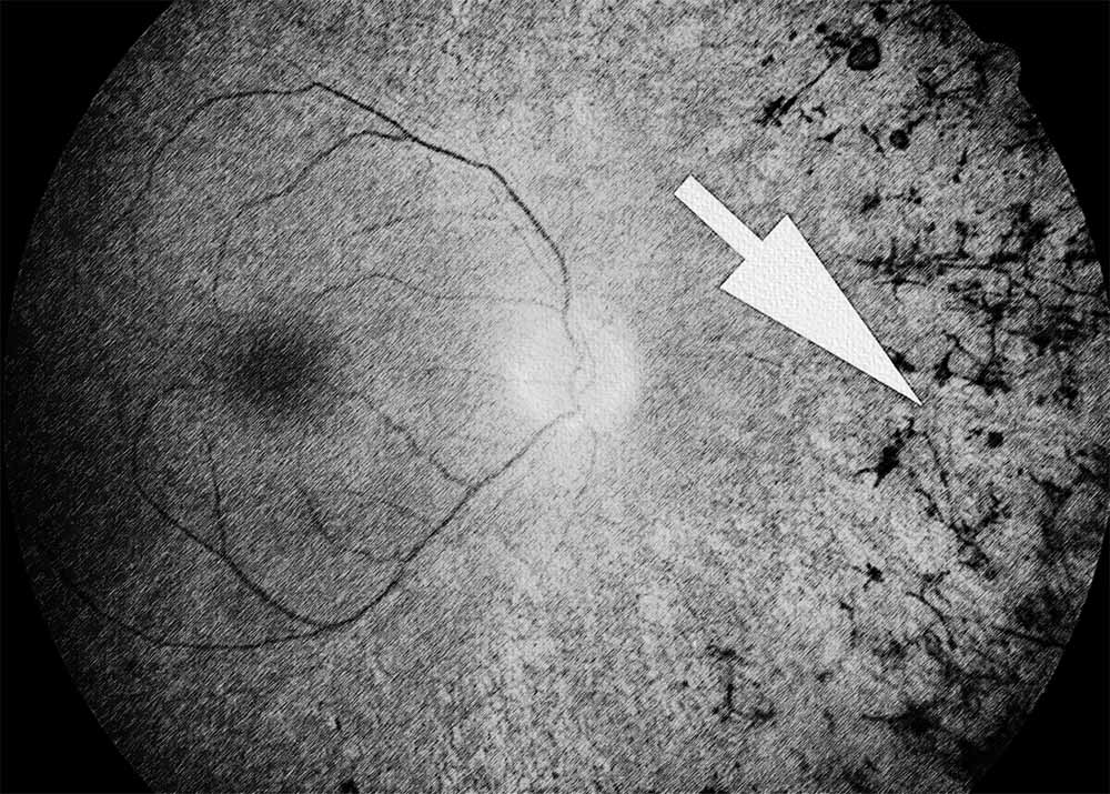 Retinitis Pigmentosa