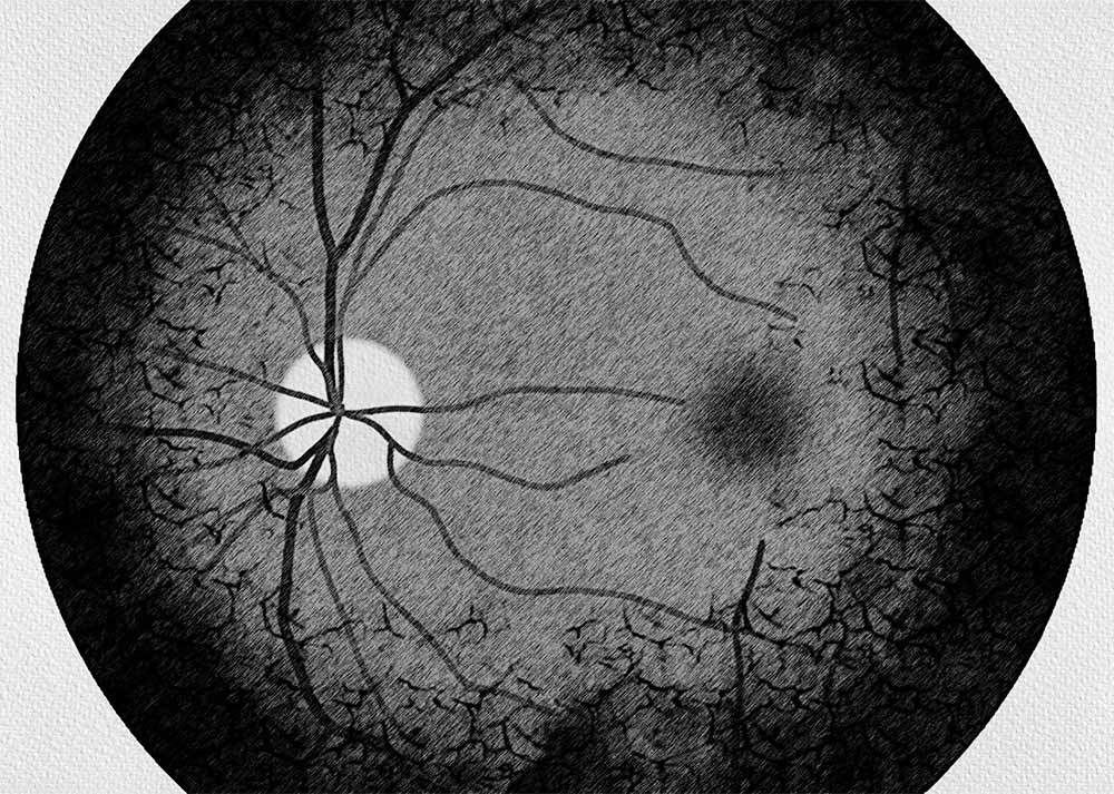 Retinitis pigmentosa (3) Retinitis Pigmentosa