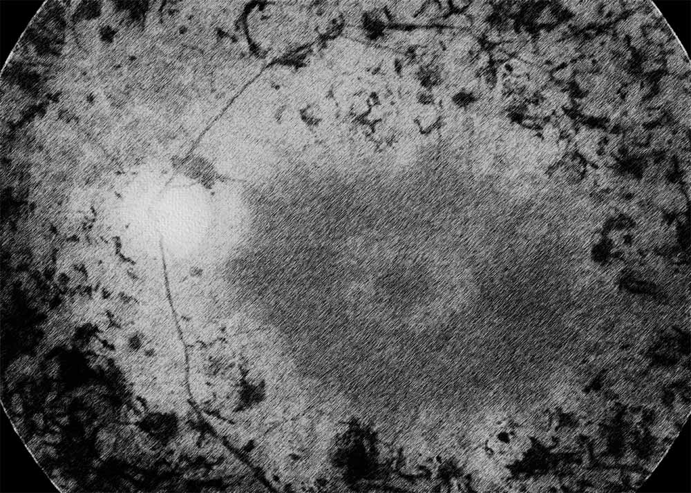 Retinitis pigmentosa (4) Retinitis Pigmentosa