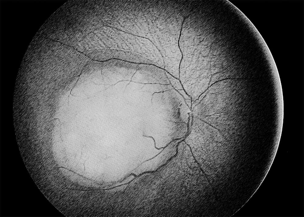 Retinoblastoma