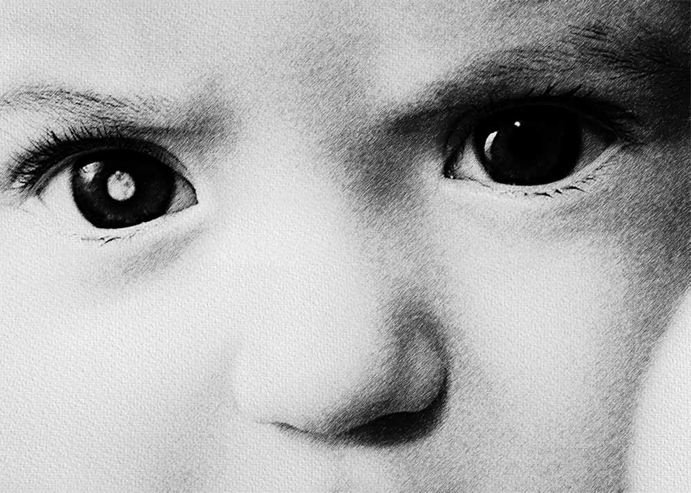 Retinoblastoma