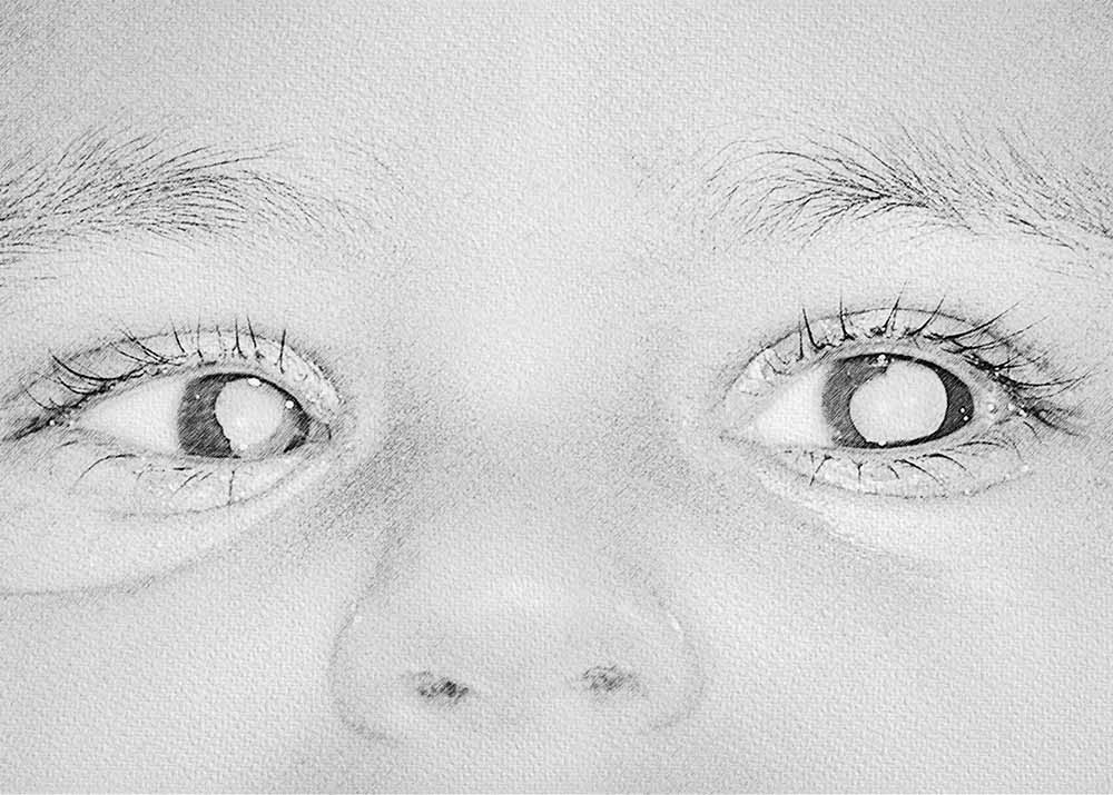 Photo copyright Aravind, 2006 Retinopathy of Prematurity