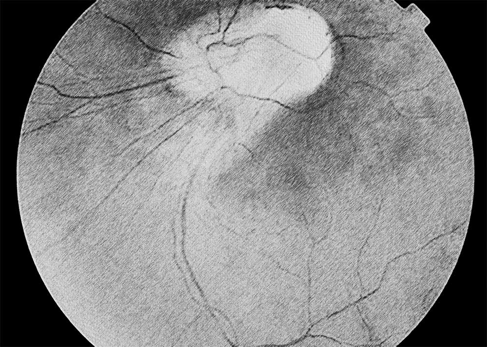 Retinopathy of Prematurity