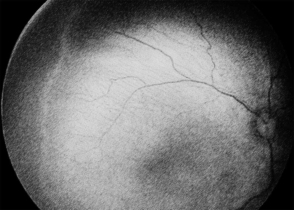 Retinopathy of Prematurity (4) Retinopathy of Prematurity