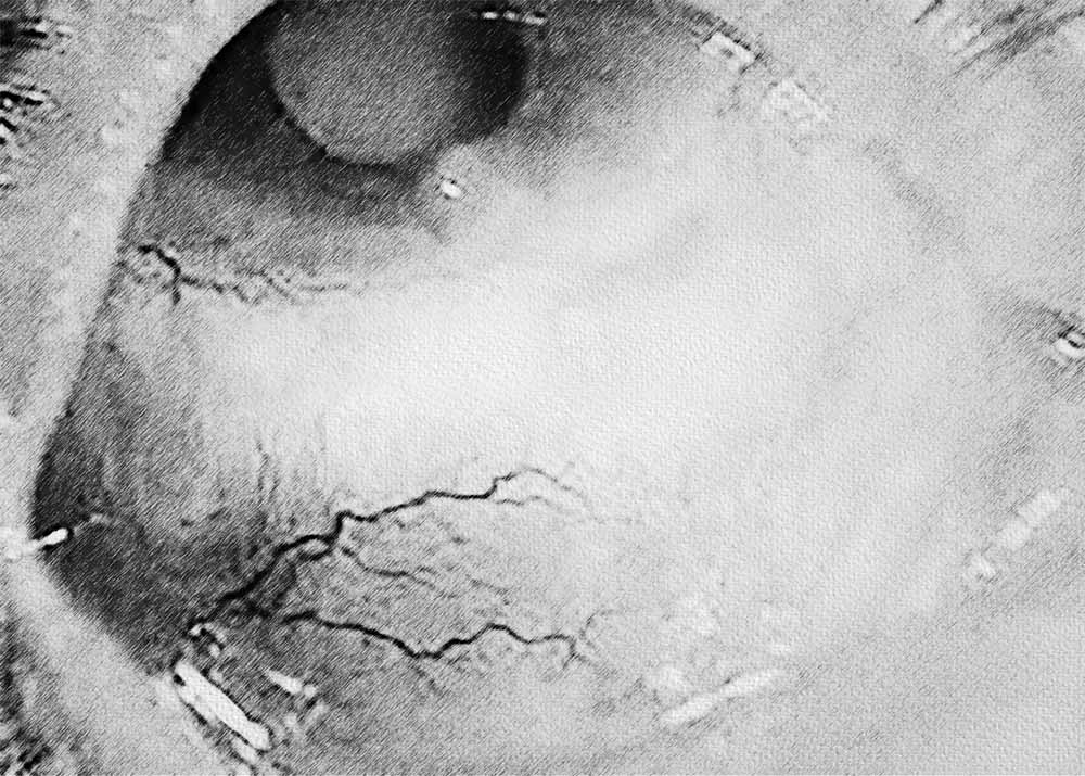 Scleritis (1) Scleritis