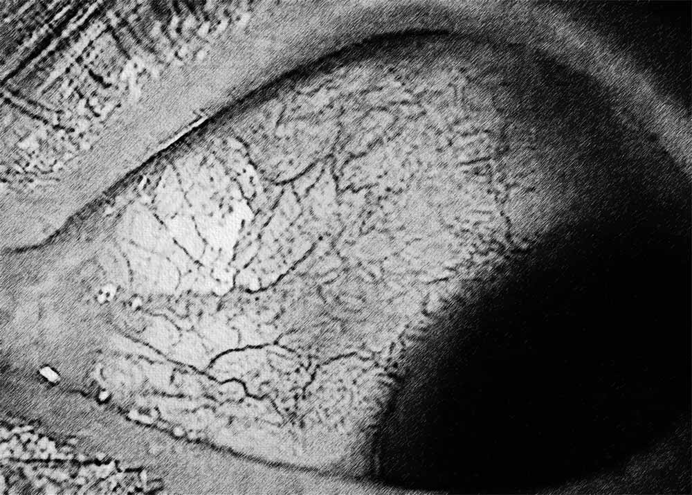 Scleritis (2) Scleritis