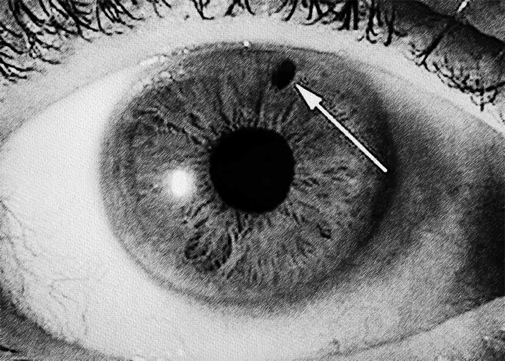 Secondary Glaucoma