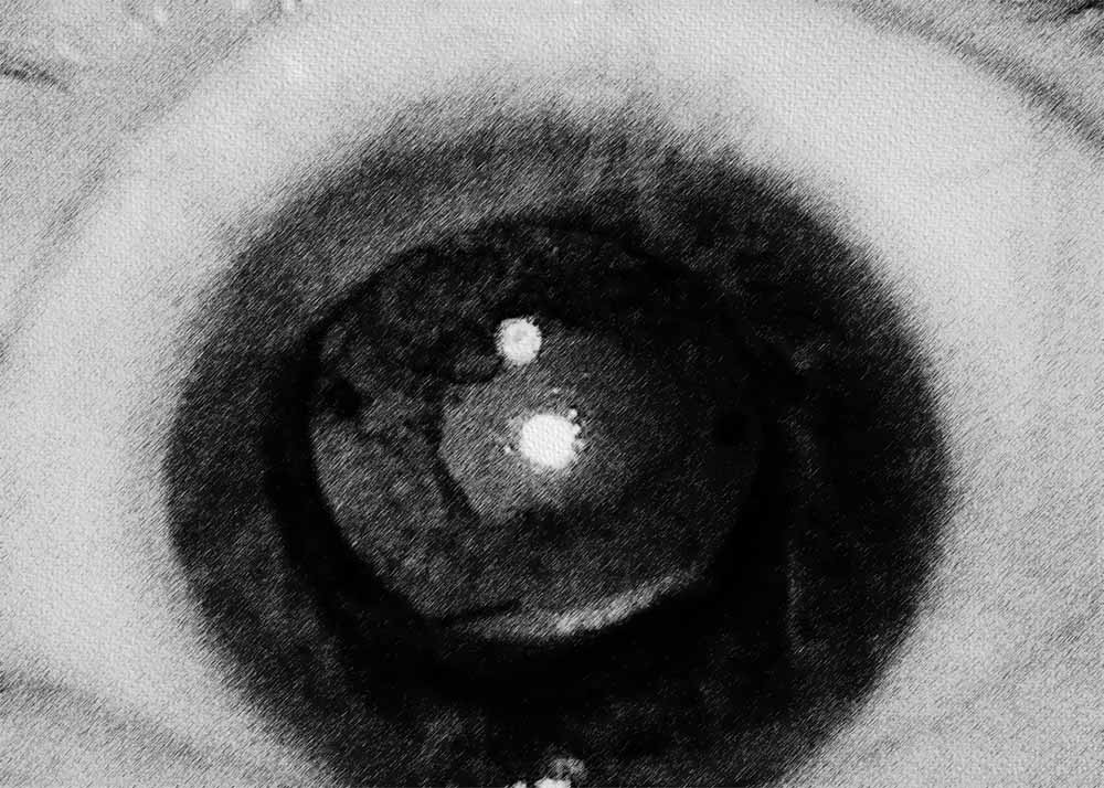 Secondary cataract