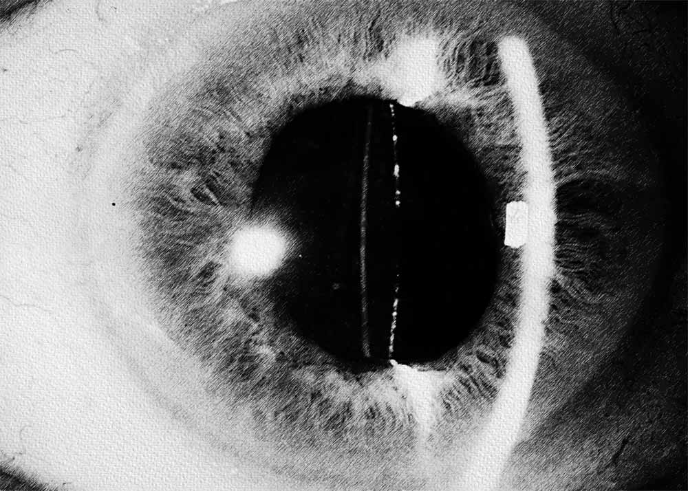 Secondary cataract