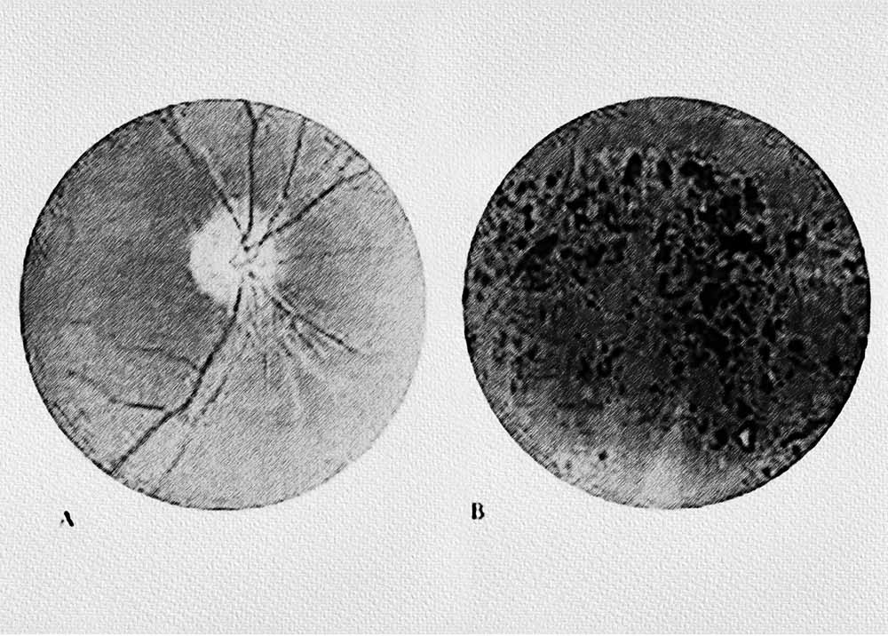 Snowflake Degeneration