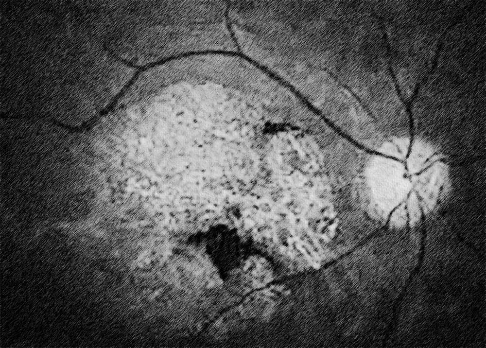 Stargardt disease (1) Stargardt Disease