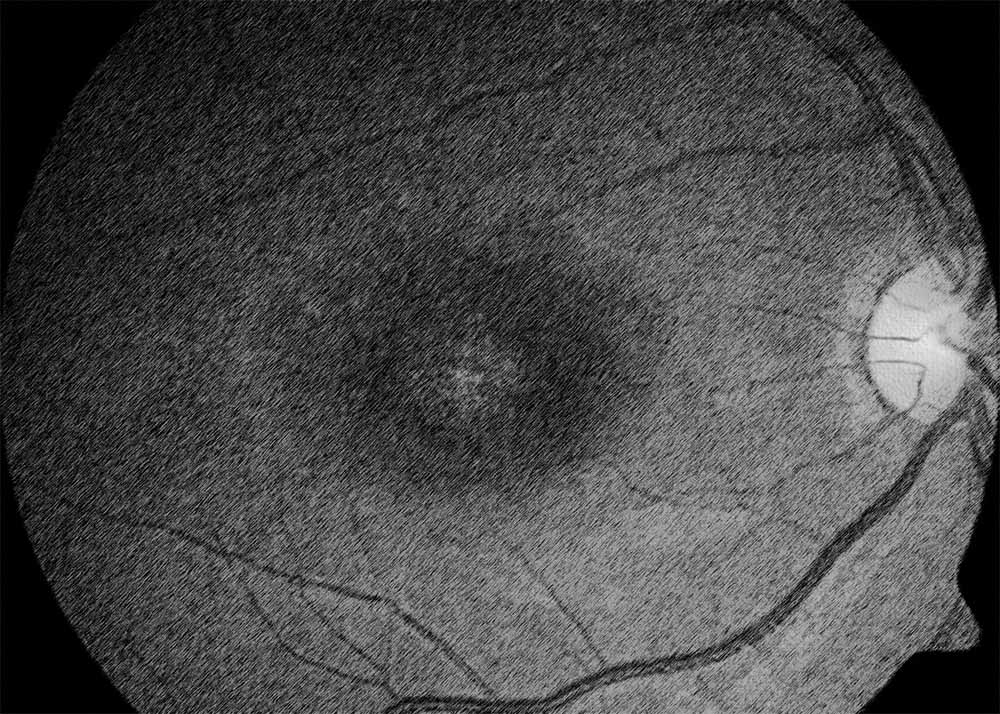Stargardt disease (3) Stargardt Disease