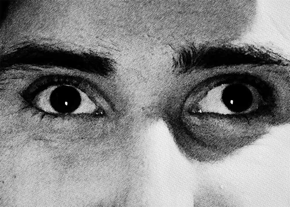 Strabismus (1) Strabismus