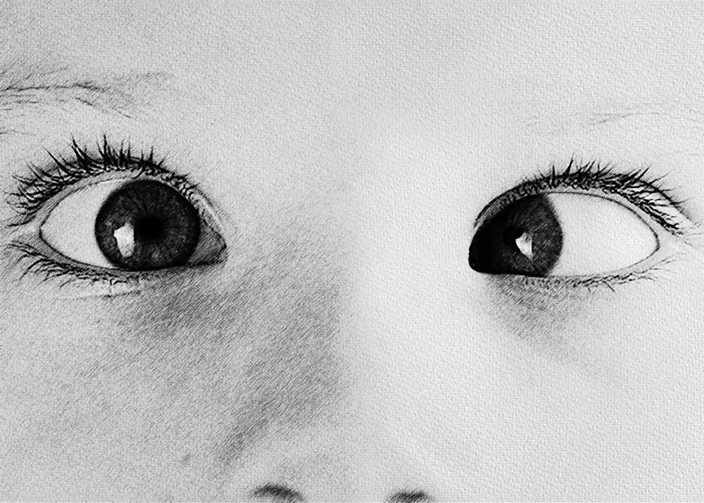 Strabismus (3) Strabismus