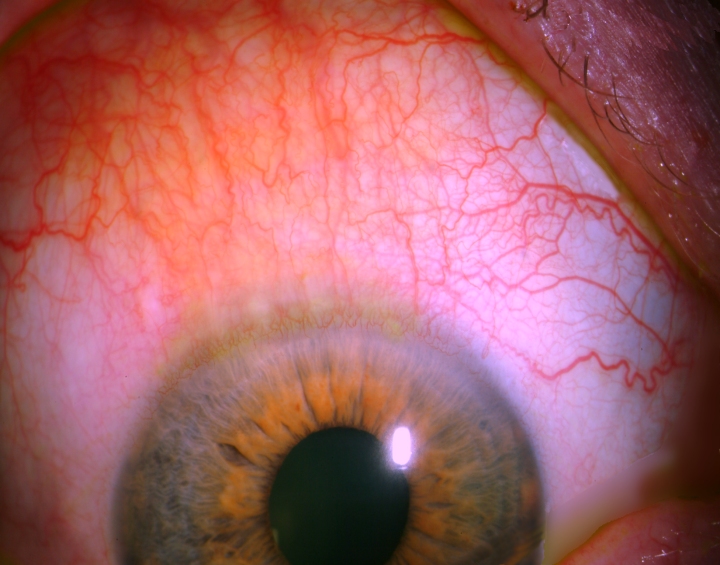 Superior Limbic Keratoconjunctivitis Superior Limbic Keratoconjunctivitis (SLK)