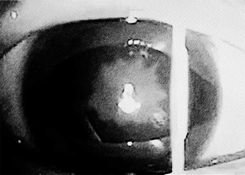 Traumatic cataract (1) (1) Traumatic cataract