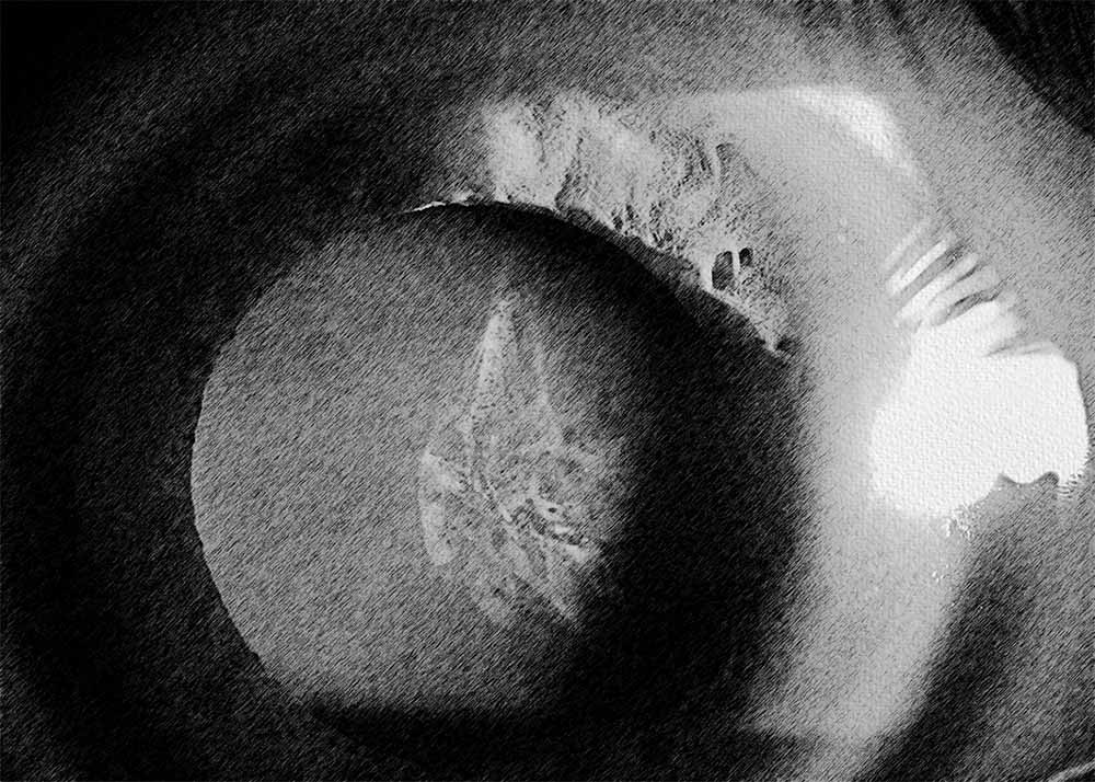 Traumatic cataract