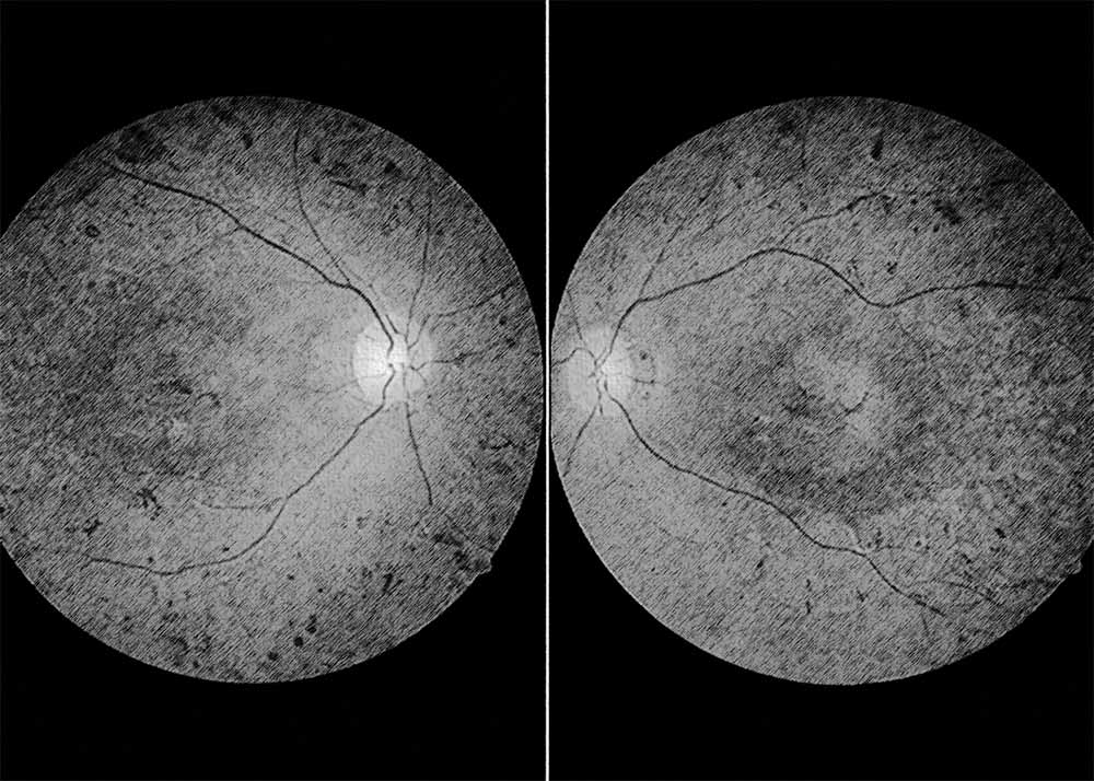 Usher Syndrome