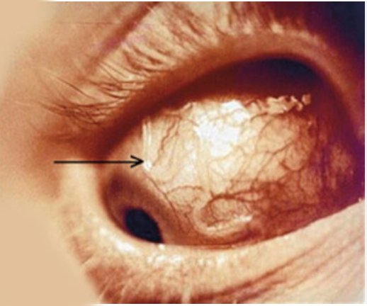 Parasitic Eye Disorders