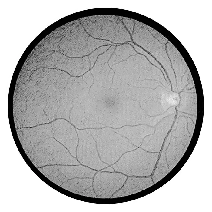 10. Macular degeneration